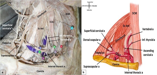 Bilateral variation in the branching pattern of the subclavian artery: an unusual finding with clinical implications.