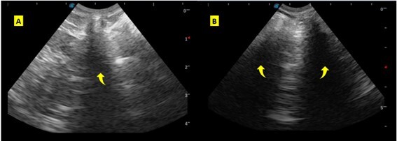 Cervical ultrasound for endotracheal intubation confirmation in dogs by veterinary students: a cadaveric study.