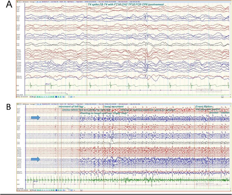 SEEG-RF for revealing and treating Geschwind syndrome's epileptic network: A case study