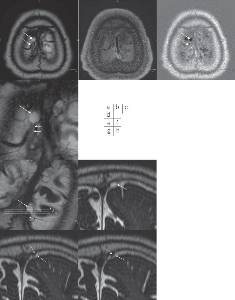 Parasagittal Cystic Lesions May Arise from the Pial Sheath around the Cortical Venous Wall.