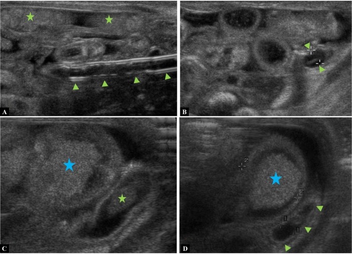 Sonographic Rectal Enema ("hydrocolon") for Diagnosing Large Bowel Pathologies in Infancy - Pictorial Review to Demonstrate Feasibility and Value.