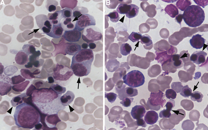 Ultrastructural characteristics of erythroid cells in congenital dyserythropoietic anemia type II, with a focus on peripheral cisternae and double membranes.