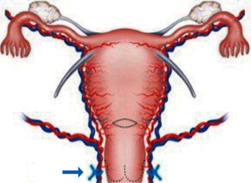 Cesarean Scar Pregnancy and Successful Ultrasound-Guided Removal after Uterine Artery Ligation.