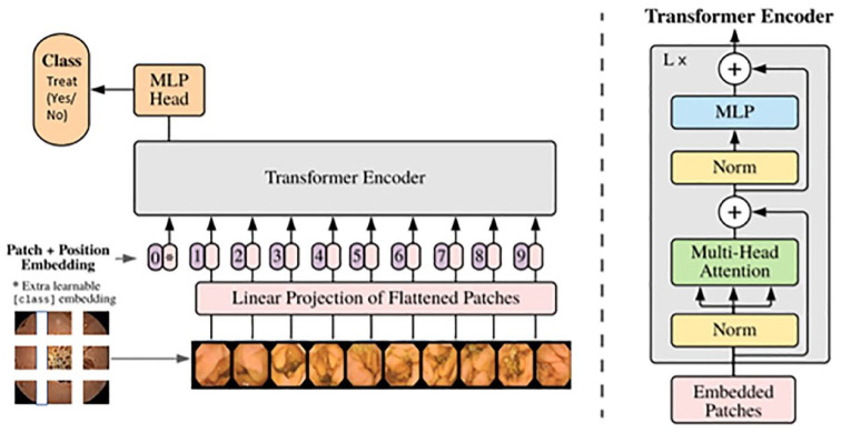 Spatiotemporal analysis of small bowel capsule endoscopy videos for outcomes prediction in Crohn's disease.