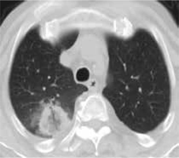 Ablation of pulmonary neoplasms: review of literature and future perspectives.