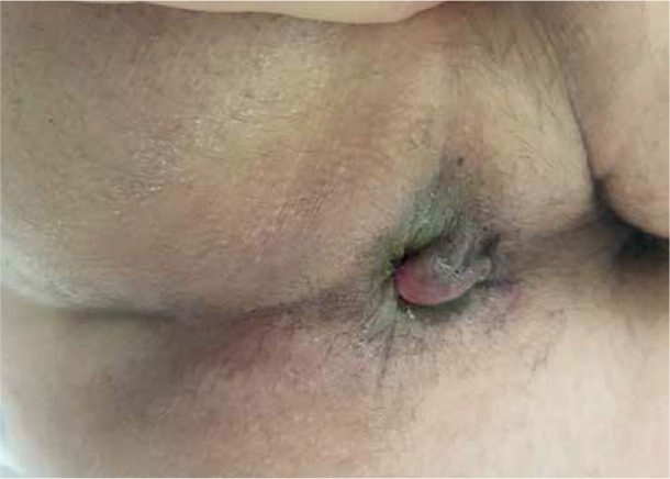 A combined method for the treatment of grade IV internal haemorrhoidal disease.