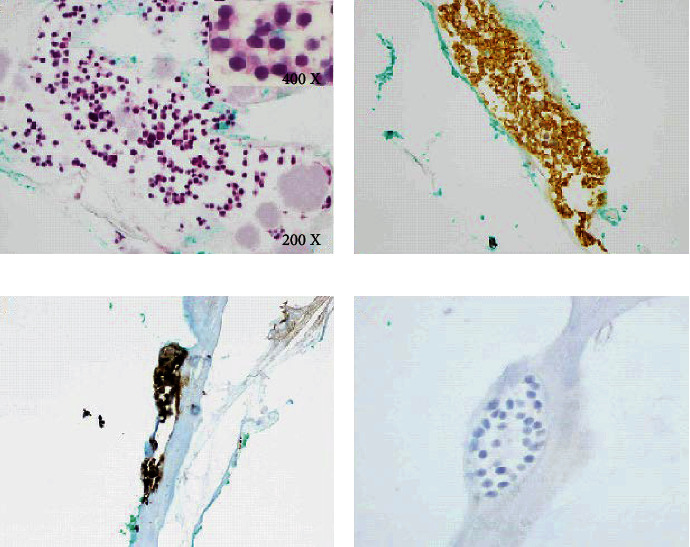 Retinocytoma Undergoing Retinoblastoma Transformation in an Adult Patient.