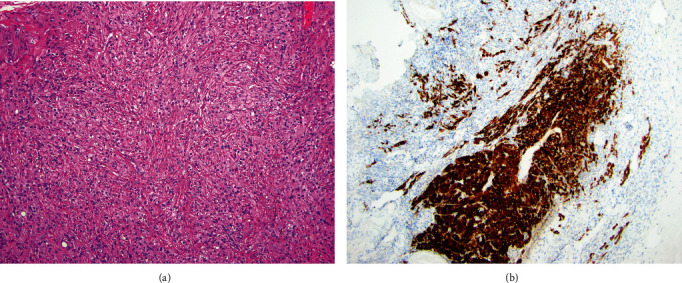 Varying Phenotypes of Leydig Cell Hyperplasia of the Ovary: Two Case Reports.