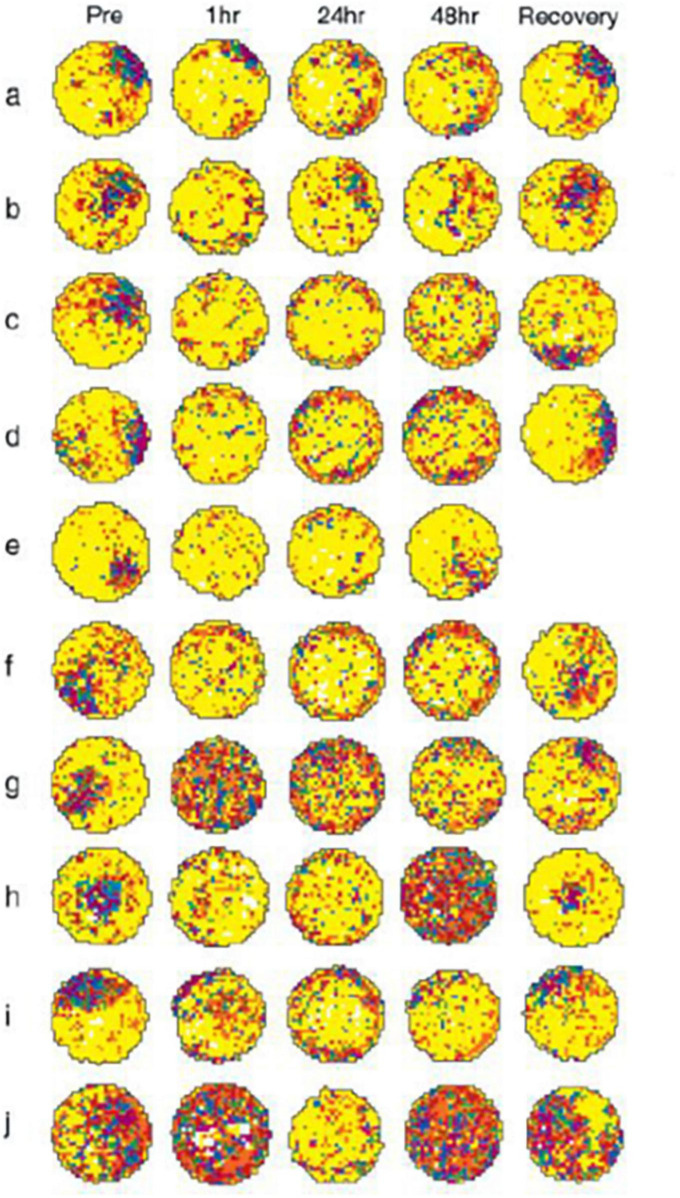 Interpreting the meaning of changes in hippocampal volume associated with vestibular loss.