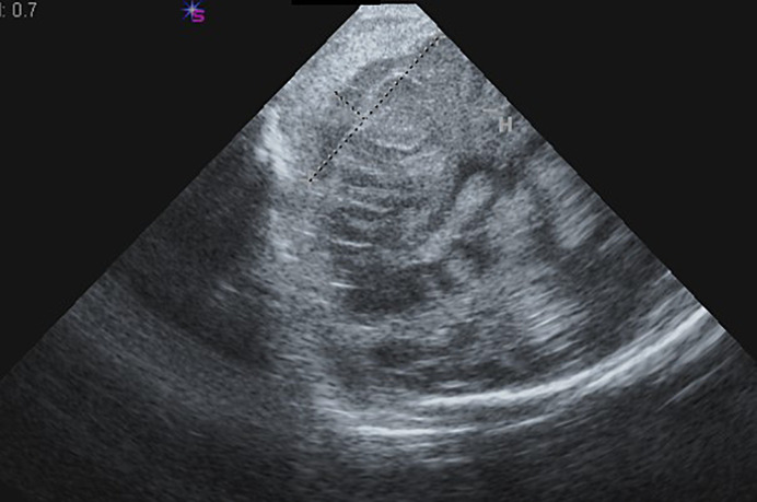 Warfarin-Associated Fetal Subdural Hematoma Causing Severe Neurodevelopmental Delay: A Case Report.