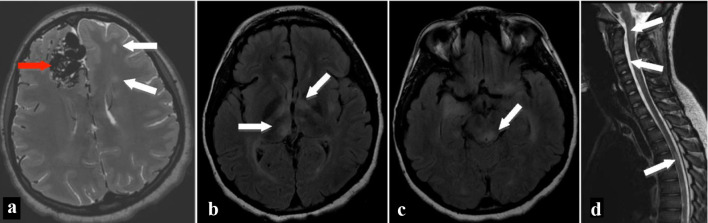 Clinically Isolated Syndrome and Frontal Lobe Arteriovenous Malformation Presenting With Behavior Issues.