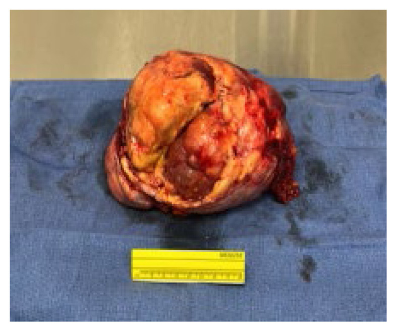 Adrenocortical Carcinoma as an Atypical Cause of Secondary Hypertension.