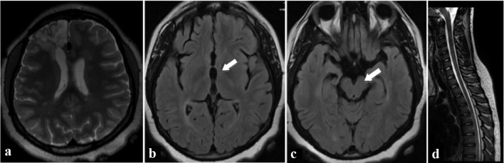 Clinically Isolated Syndrome and Frontal Lobe Arteriovenous Malformation Presenting With Behavior Issues.