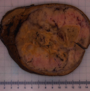 A Case of Hepatic Malignant Solitary Fibrous Tumor: A Case Report and Review of the Literature.