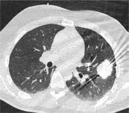 Ablation of pulmonary neoplasms: review of literature and future perspectives.