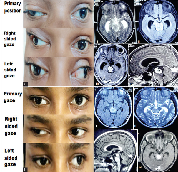 Studded Brainstem Tuberculoma Presenting with Bilateral Inter-Nuclear Ophthalmoplegia.