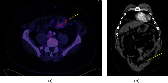 Solitary Abdominal Wall Lymph Node Recurrence in Prostate Cancer Patient with Dramatic Prostate-Specific Antigen Decrease following Metastasectomy.