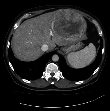 A Case of Hepatic Malignant Solitary Fibrous Tumor: A Case Report and Review of the Literature.