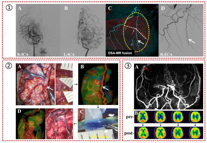 Designing a flow-controlled STA-MCA anastomosis based on the Hagen-Poiseuille law for preventing postoperative hyperperfusion in adult moyamoya disease.