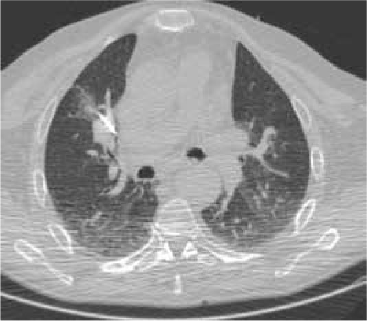 Ablation of pulmonary neoplasms: review of literature and future perspectives.