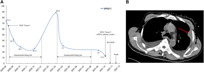 Case report: Circulating tumor DNA technology displays temporal and spatial heterogeneity in Waldenström macroglobulinemia during treatment with <i>BTK</i> inhibitors.