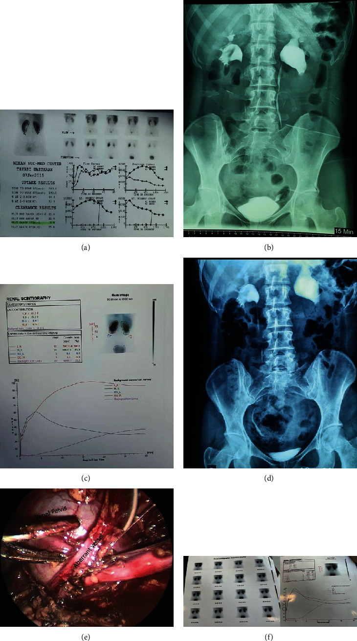 Progressive Ureteropelvic Junction Obstruction and Renal Function Deterioration in Adult, Even in a Short Period of Time.