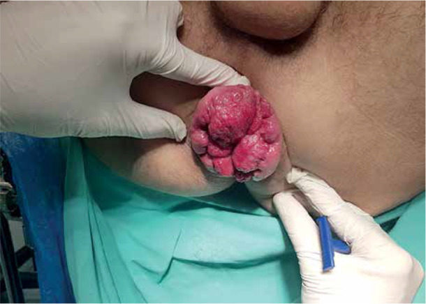 A combined method for the treatment of grade IV internal haemorrhoidal disease.