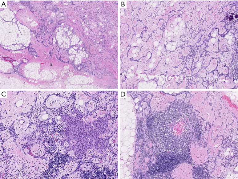 Asymptomatic lipofibroadenoma in a 17-year-old male: a case report and literature review of a rare entity.