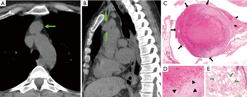 Intralesional microbleeding in resected thymic cysts indeterminate on imaging.