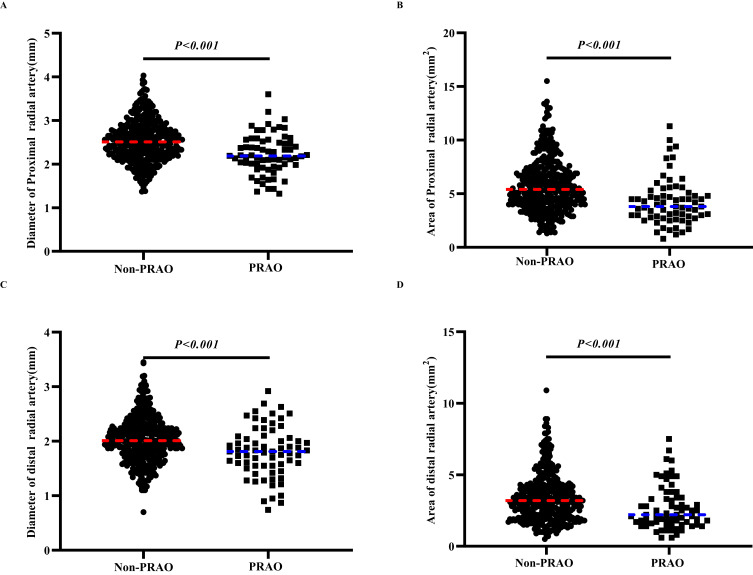 Factors Affecting Radial Artery Occlusion After Right Transradial Artery Catheterization for Coronary Intervention and Procedures.