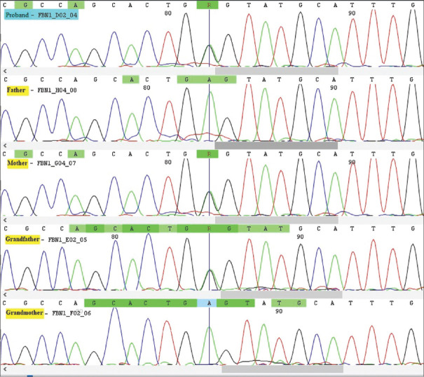 A Novel Missense Mutation in the TGF-β-binding Protein-Like Domain 3 of <i>FBN1</i> Causes Weill-Marchesani Syndrome with Intellectual Disability.