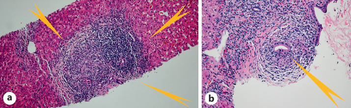 Distinction between Mitochondrial Antibody-Positive and -Negative Primary Biliary Cholangitis.