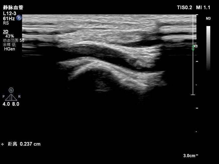 Factors Affecting Radial Artery Occlusion After Right Transradial Artery Catheterization for Coronary Intervention and Procedures.