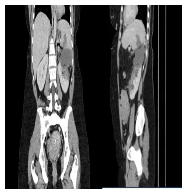 Adrenocortical Carcinoma as an Atypical Cause of Secondary Hypertension.