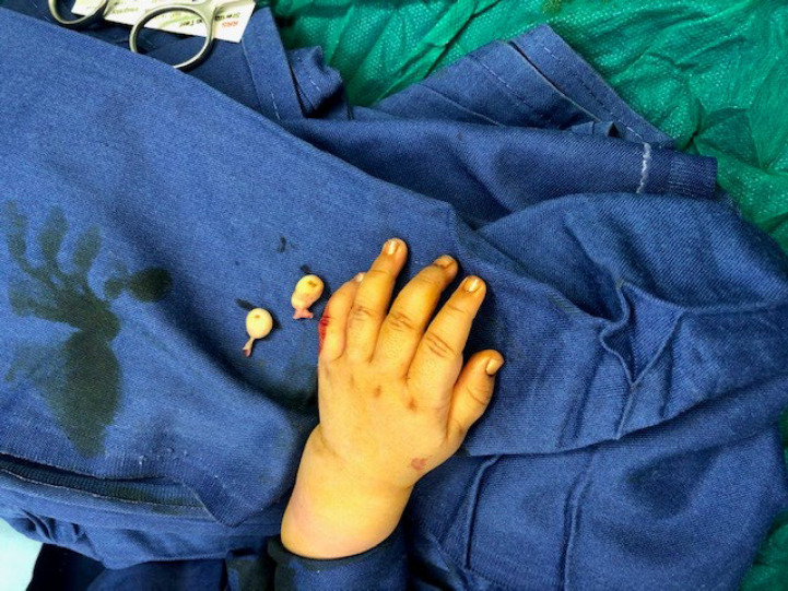 Polydactylyof 5<sup>th</sup> Finger in a 6 Month Old Male: A Case Report.