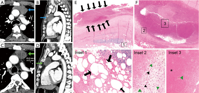 Intralesional microbleeding in resected thymic cysts indeterminate on imaging.