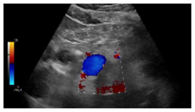 Adrenocortical Carcinoma as an Atypical Cause of Secondary Hypertension.