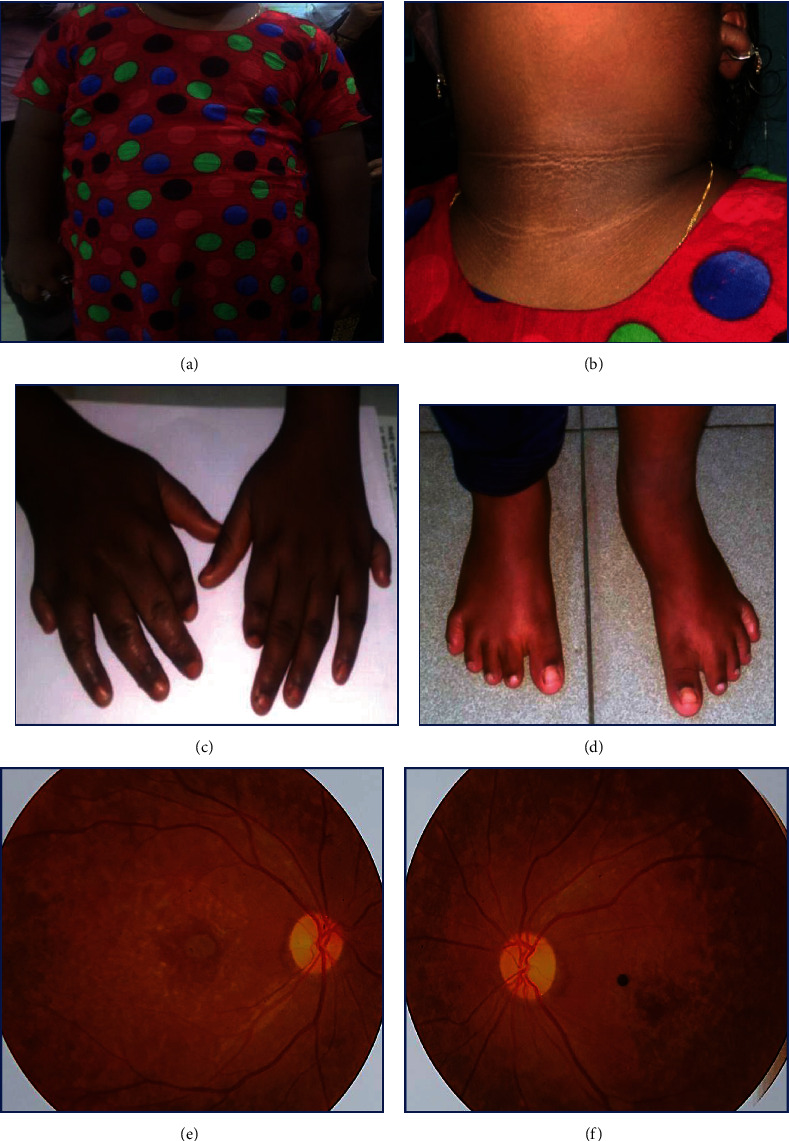 Bangladeshi Case Series of Bardet-Biedl Syndrome.