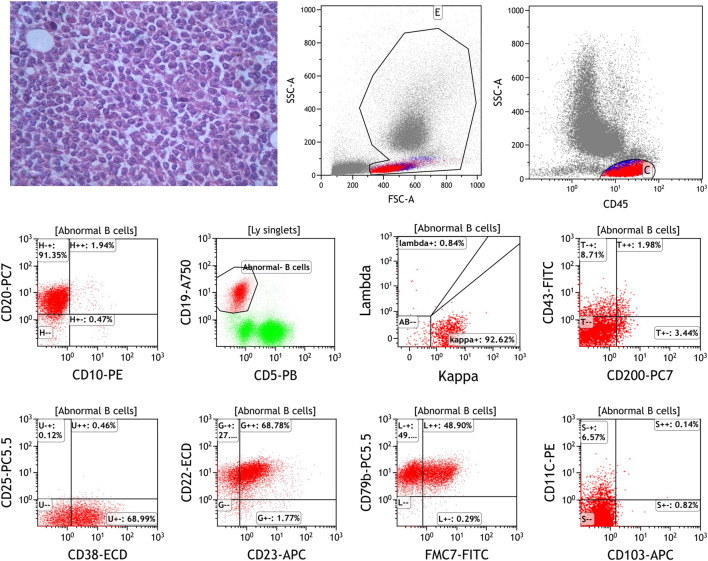 Case report: Circulating tumor DNA technology displays temporal and spatial heterogeneity in Waldenström macroglobulinemia during treatment with <i>BTK</i> inhibitors.