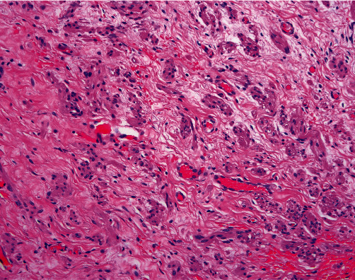 Varying Phenotypes of Leydig Cell Hyperplasia of the Ovary: Two Case Reports.