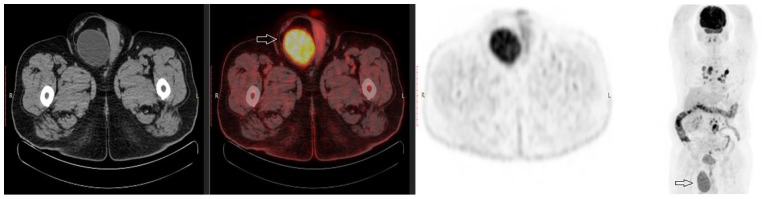 Inguinoscrotal Bladder Hernia Mimicking Testicle Tumor.