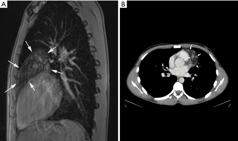 Asymptomatic lipofibroadenoma in a 17-year-old male: a case report and literature review of a rare entity.