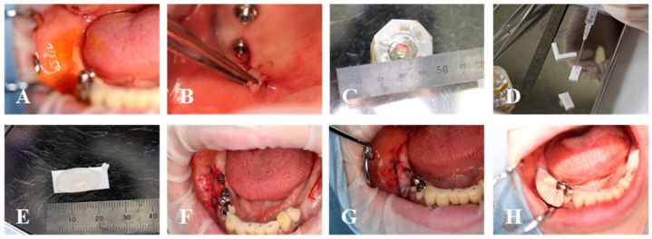 First-in-Human Study to Investigate the Safety Assessment of Peri-Implant Soft Tissue Regeneration with Micronized-Gingival Connective Tissue: A Pilot Case Series Study.