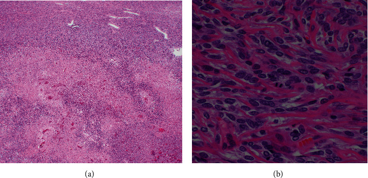 A Case of Hepatic Malignant Solitary Fibrous Tumor: A Case Report and Review of the Literature.