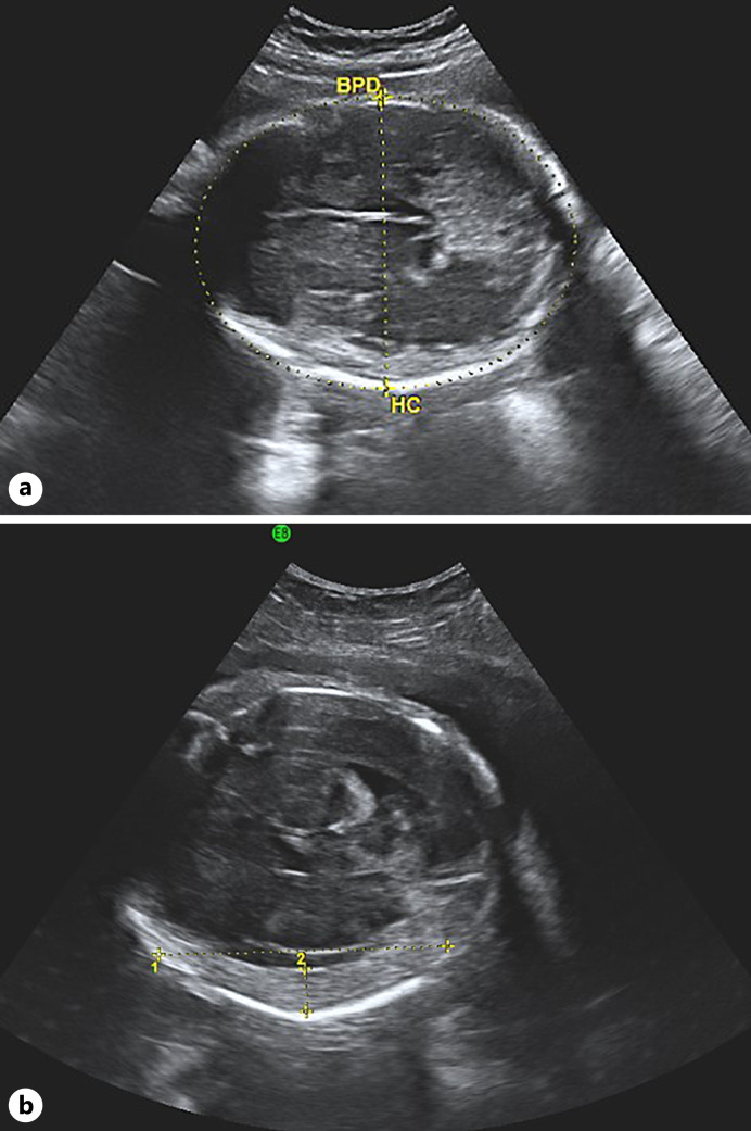 Warfarin-Associated Fetal Subdural Hematoma Causing Severe Neurodevelopmental Delay: A Case Report.