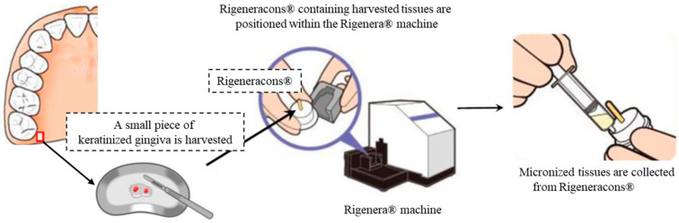 First-in-Human Study to Investigate the Safety Assessment of Peri-Implant Soft Tissue Regeneration with Micronized-Gingival Connective Tissue: A Pilot Case Series Study.