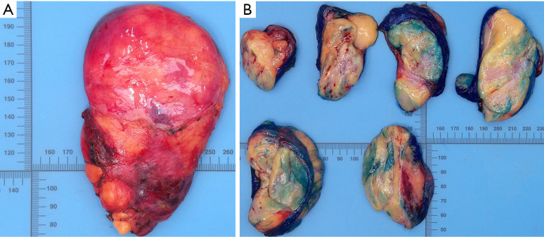 Asymptomatic lipofibroadenoma in a 17-year-old male: a case report and literature review of a rare entity.