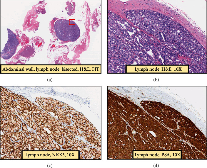 Solitary Abdominal Wall Lymph Node Recurrence in Prostate Cancer Patient with Dramatic Prostate-Specific Antigen Decrease following Metastasectomy.