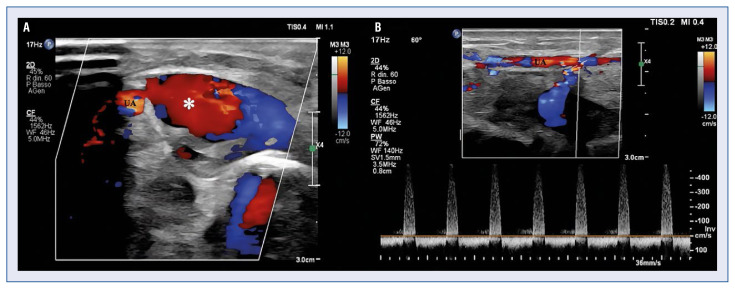 Ulnar artery thrombosis after percutaneous thrombin injection of a pseudoaneurysm with a concomitant radial artery occlusion: Three complications after percutaneous coronary intervention.