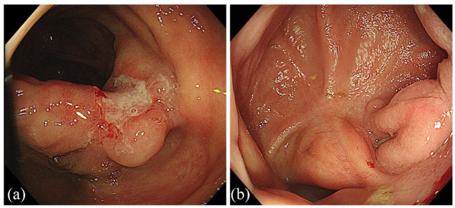 The treatment principles and targets for intestinal Behcet's disease.